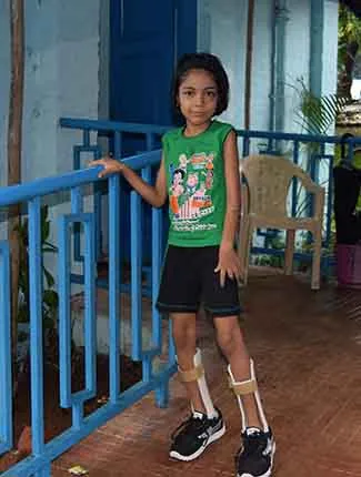 Artificial Limb